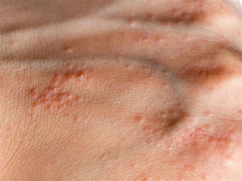Itchy Rash Treatment What Causes A Pimple Like Rash