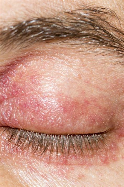 It results in itchy, red, swollen, and cracked skin. Eyelid dermatitis: Treatment, symptoms, and causes