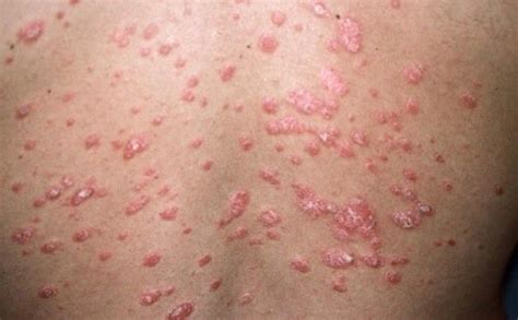What Is Psoriasis And What Are The Different Kinds Step To Health
