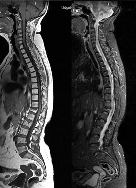Dr Balaji Anvekar Frcr Radiation Induced Spinal Cord Injury