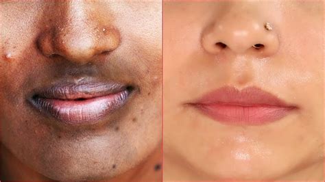 How To Remove Dark Patchesspotshyper Pigmentation Around Your Mouth