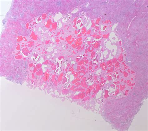 Pathology Cases — Hepatic Hemangioma Billoblog
