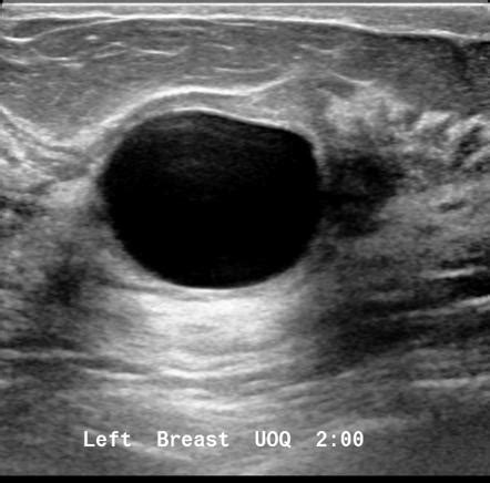 Simple Breast Cyst Radiology Reference Article Radiopaedia Org