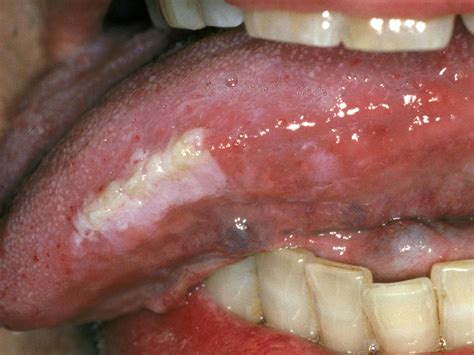 Morsicatio Mucosae Oris—a Chronic Oral Frictional Keratosis Not A