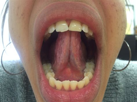Orofacial Myofunctional Therapy And Frenectomy Tongue Tie Surgery And