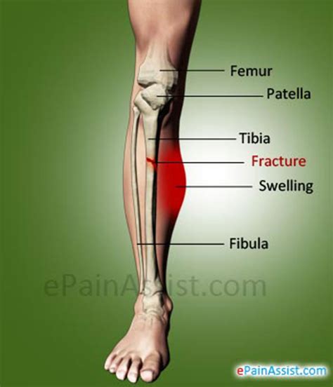 Shin Fracture Or Fracture Of Tibiacauses Symptoms Types Treatment