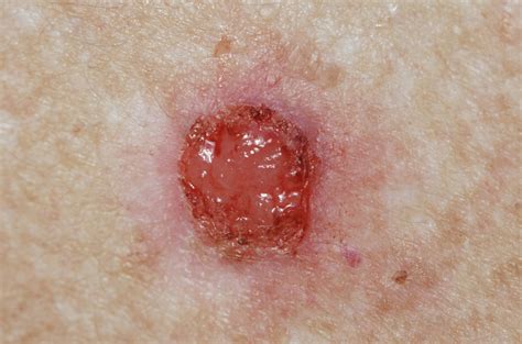 Basal Cell Carcinoma Skin Cancer Bronx Nyc