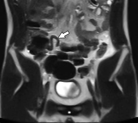 Mri For Pediatric Appendicitis In An Adult Focused General Hospital A