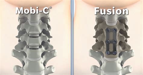 New Procedure Improves Cervical Spine Surgery Outcomes