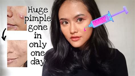 My Acne Injection Story ⎮ Before And After ⎮ English ⎮ Vlog 45 Youtube