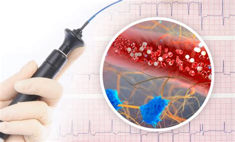 Catheter Ablation Get Images
