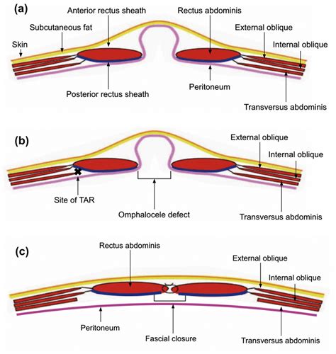 A Layers Of Abdominal Wall B Abdominal Wall With Component Separation