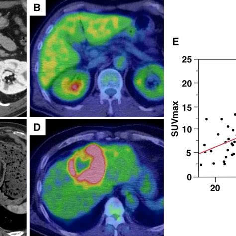 Representative Positron Emission Tomographycomputed Tomography