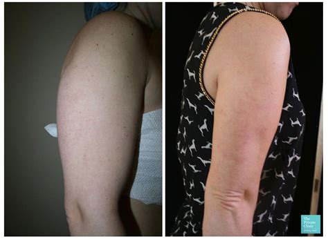 Non Surgical Fat Removal Liposuction For Women Before And After Photos