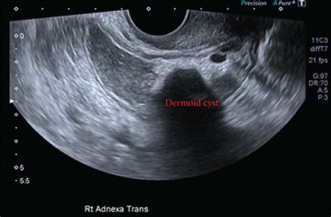 Ultrasound Showing A Large 10 Cm Well Circumscribed Dermoid Cyst