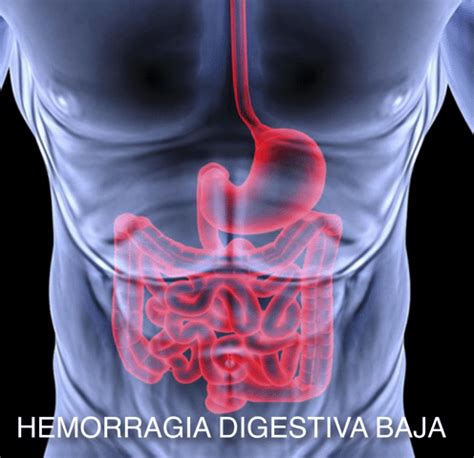 Hemorragia Digestiva Baja Qu Es Signos S Ntomas Y M S