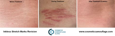 Inkless Stretchmarks Cosmetic Camouflage Clinic