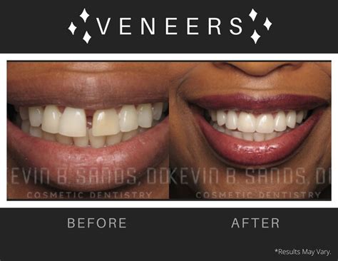 Filling The Gaps Veneers Implants And Dental Bonding Dr Kevin Sands