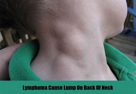 Causes And Symptoms Of Lump On Back Of Neck Natural Home Remedies And Supplements