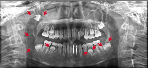 Figure 1 From Nevoid Basal Cell Carcinoma Syndrome A Case Report And