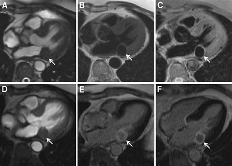 Multimodality Cardiac Imaging In The Evaluation Of Mitral Annular