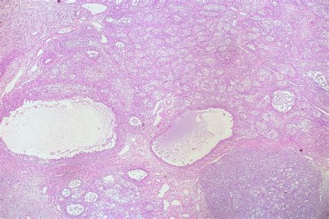 Juvenile Granulosa Cell Tumor Flickr Photo Sharing