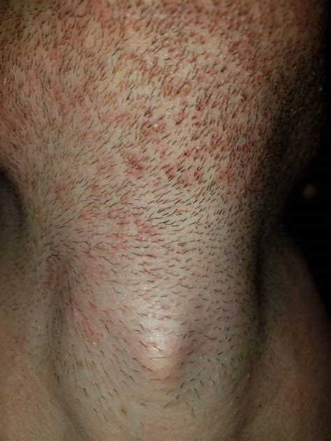 Pseudofolliculitis Barbae With Close Up Photos Badger And Blade