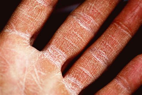 Eczema Treatment Singapore Dermatologist Tips Twl Skin