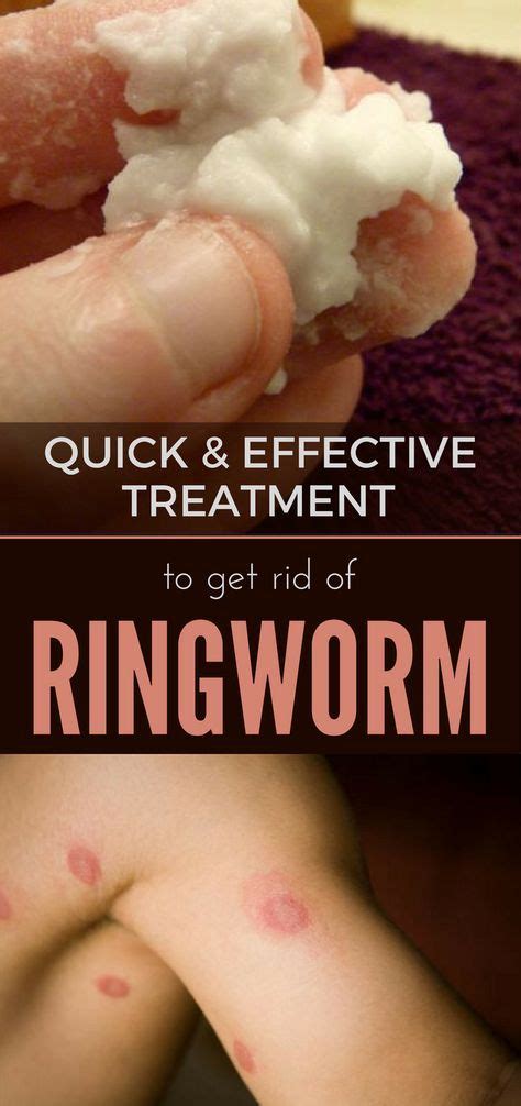 Quick And Effective Treatment To Get Rid Of Ringworm Home Remedies