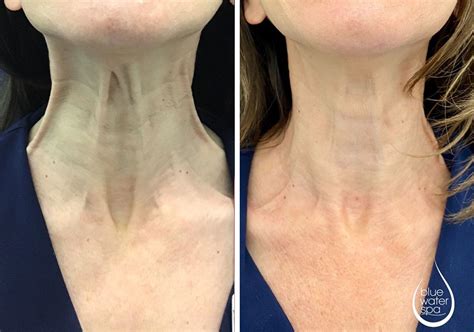 Platysmal Band Botox Neck Botox Before And After