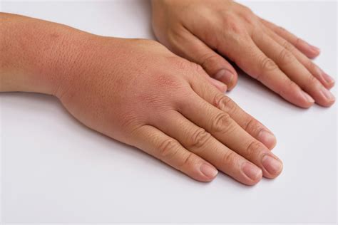 Dealing With A Swollen Hand After A Car Accident The Accident Doctors