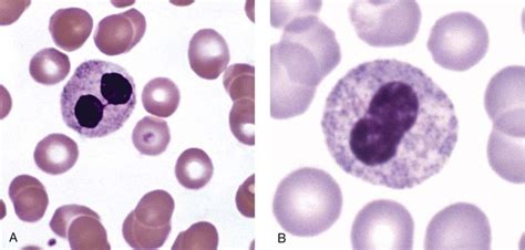 Nonmalignant Leukocyte Disorders Clinical Gate