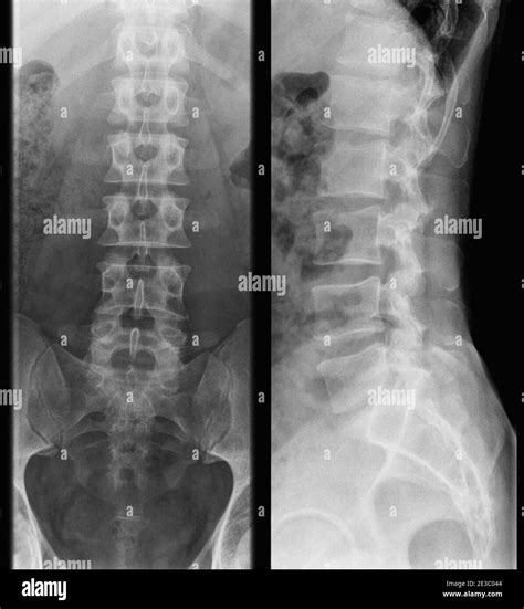 Radiografía De La Columna Lumbar Humana Hombre Adulto Vista Frontal
