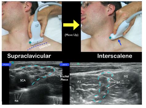 Ultrasound Guided Interscalene Brachial Plexus Nerve Block Laptrinhx Porn Sex Picture