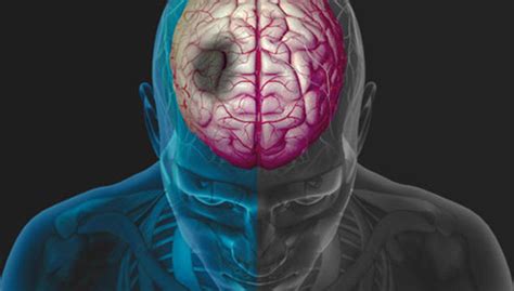 Isquemia cerebral, infarto cerebral (avc) e derrame cerebral é a mesma coisa? Los "Avisos" del Infarto Cerebral | Clí­nica Neuron