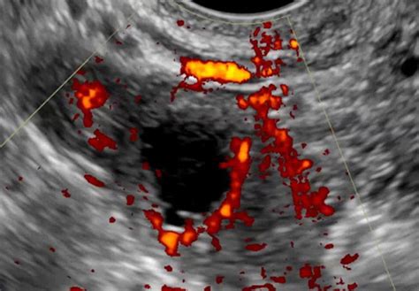 Corpus Luteum Ultrasound Image Shows A Thick Walled Cystic Structure Download Scientific
