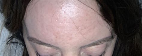 Forehead Acne Scars Scar Treatments Forum