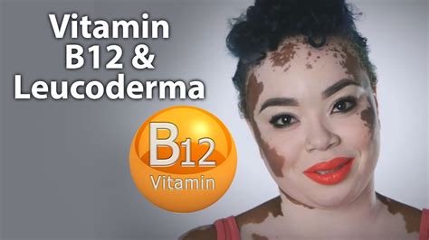 Vitamin B12 And White Patchesleucoderma Youtube