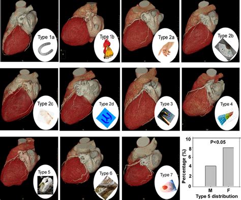 Seven Types With 6 Subtypes Of The Left Atrial Appendage Laa Based On