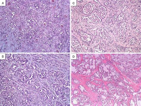 Predominant Histologic Patterns In Collecting Duct Carcinoma A