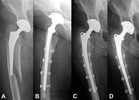 Treatment Of Periprosthetic Femoral Fractures Vancouver Type B2