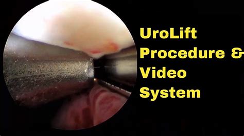 Narrated Urolift Procedure Video As Shown Using Redfin R Digital