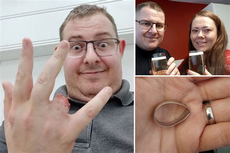 Newlyweds Ring Finger Ripped Off After His Wedding Band Got Caught On