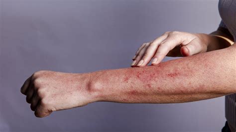 Types Of Rash Associated With An Hiv Infection Vrogue Co