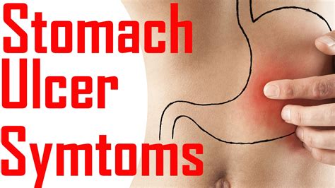 Symptoms Of Stomach Ulcers Symptoms Of Peptic Ulcers Peptic Ulcer Disease Youtube