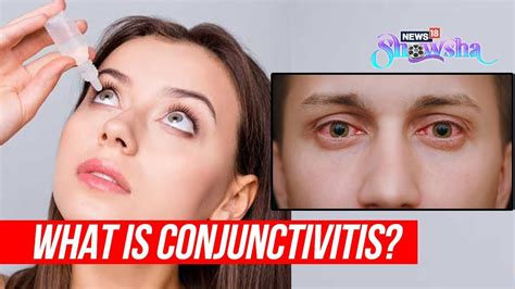 Conjunctivitis Cases On The Rise In Delhi Ncr What Is Eye Flu How To