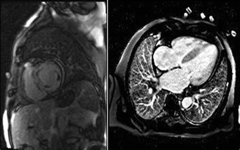 Cardiac Magnetic Resonance Cmr Images Of Patients With Cardiac