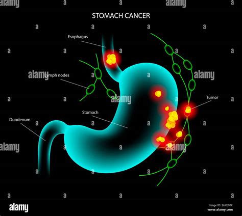 Stomach Cancer Illustration Stock Photo Alamy