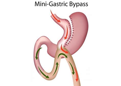 Advantages And Disadvantages Of Mini Gastric Bypass Surgery