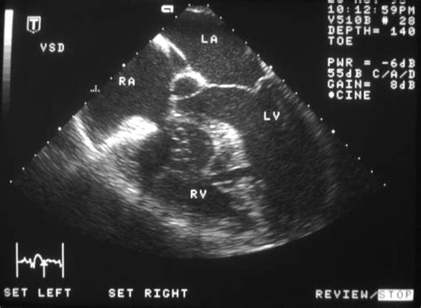 Echocardiography In Adult Congenital Heart Disease Heart